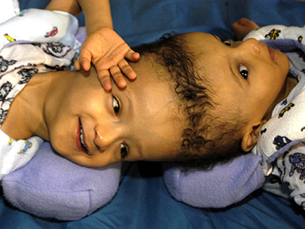 Conjoined twins - Conjoined twins (WARNING: GRAPHIC IMAGES) - Pictures ...
