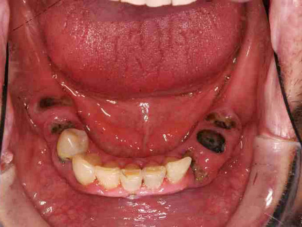 Meth Mouth Porn - Meth mouth: Inside look at icky problem (15 GRAPHIC IMAGES ...
