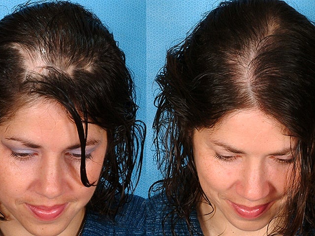 Eek Hair Loss In Women Top 7 Risk Factors Revealed Pictures