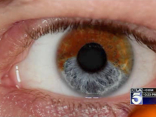 Laser procedure turns brown eyes blue, scientist says