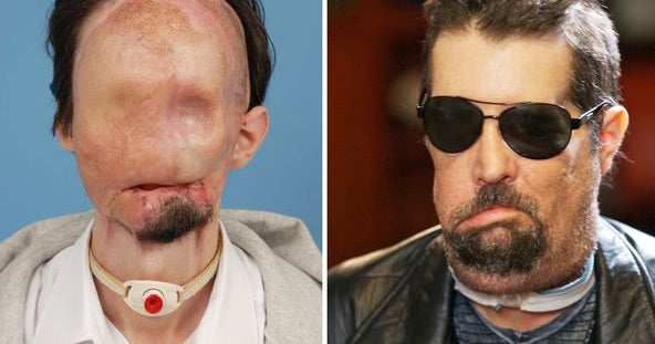Amazing Face Transplants Graphic Images Cbs News
