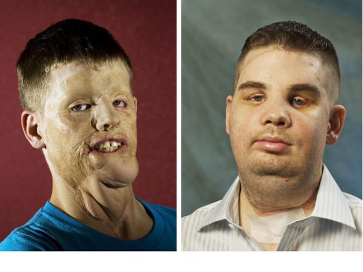 Face transplant surgery How are patients now? CBS News