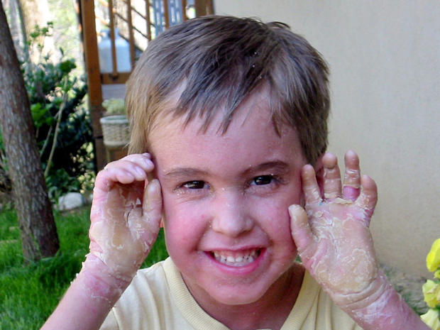 Harlequin ichthyosis - 9 uncommon skin conditions ...