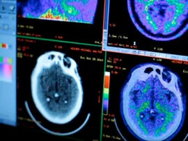 Obama pledges $130M for Alzheimer's research