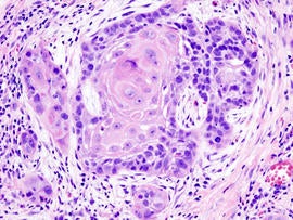 Cancer cells