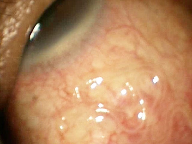 5inch worm removed from man's eye (GRAPHIC IMAGES) CBS News