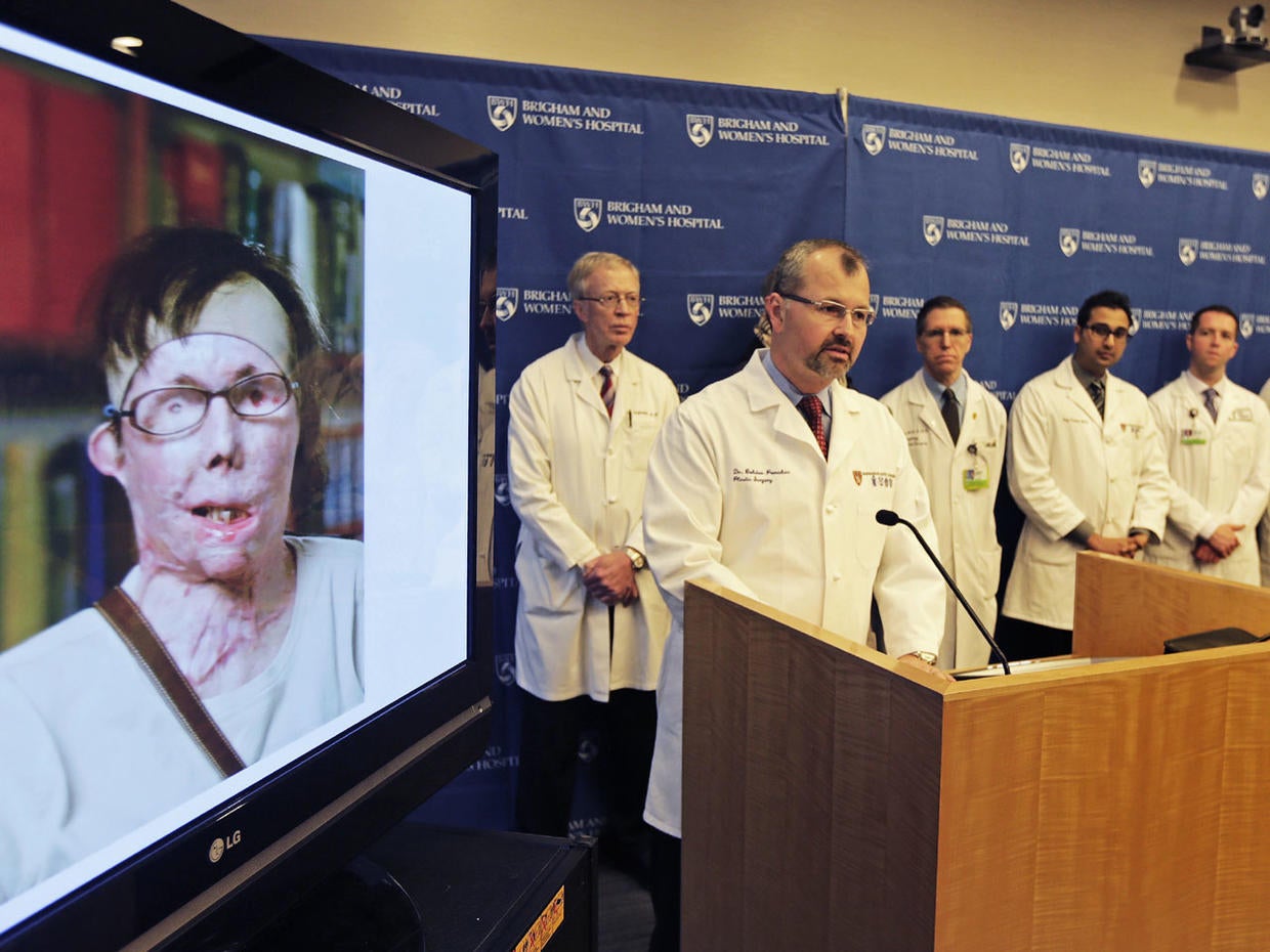Face transplant Amazing face transplants (GRAPHIC IMAGES) CBS News