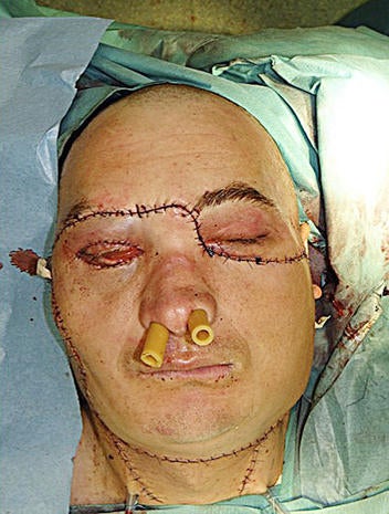 Face Transplant Amazing Face Transplants Graphic Images Pictures Cbs News Face Transplant Amazing Face Transplants Graphic Images Pictures Cbs News