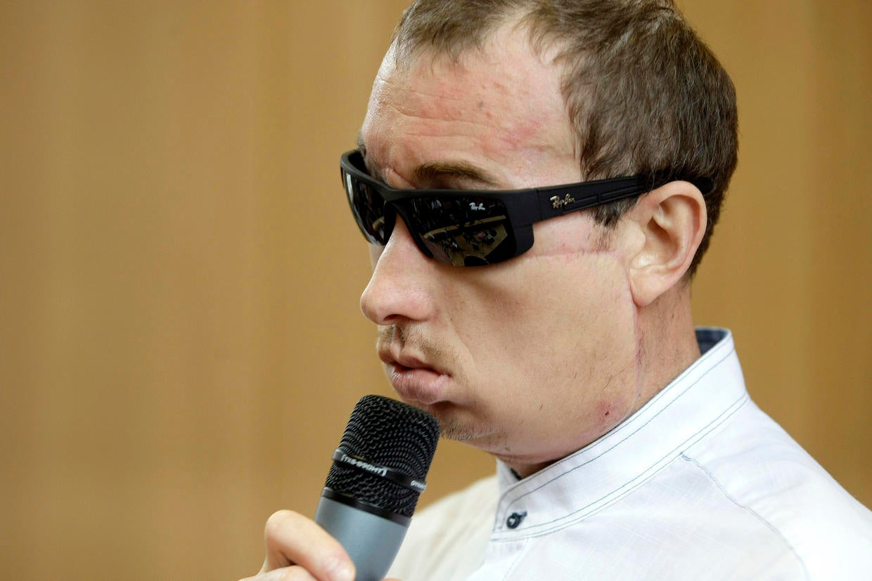 Polish face transplant patient leaves hospital Photo 3 Pictures