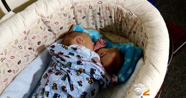 Parents in Pennsylvania opt to keep conjoined twins together CBS News