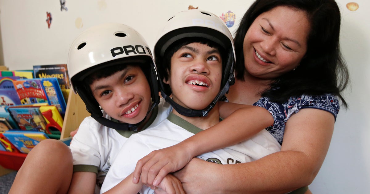 Twin Study Raises Doubts About >> Once Conjoined Twins Clarence And Carl Aguirre Celebrate 10 Years Of Twin Study Raises Doubts About >> Once Conjoined Twins Clarence And Carl Aguirre Celebrate 10 Years Of