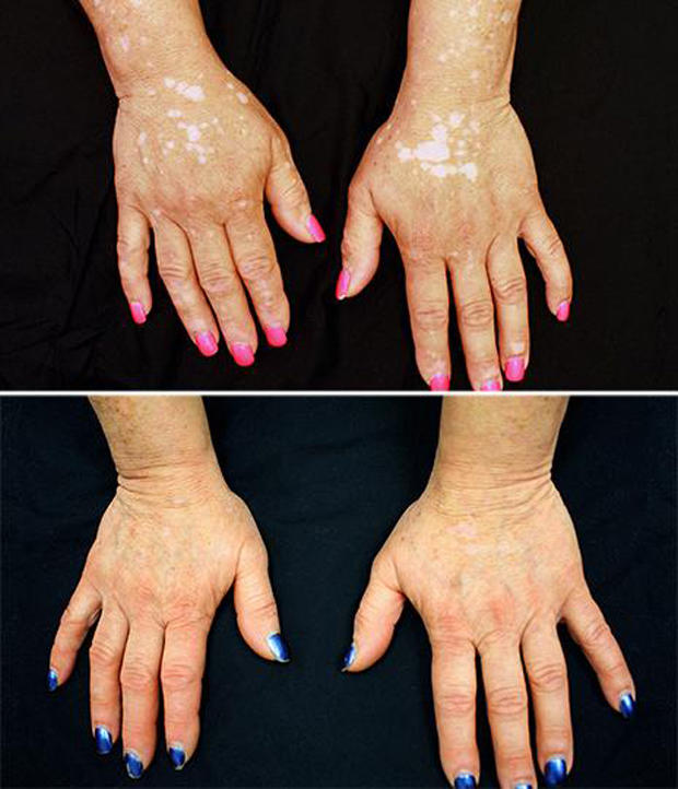 Arthritis drug treats woman s vitiligo  skin pigment 