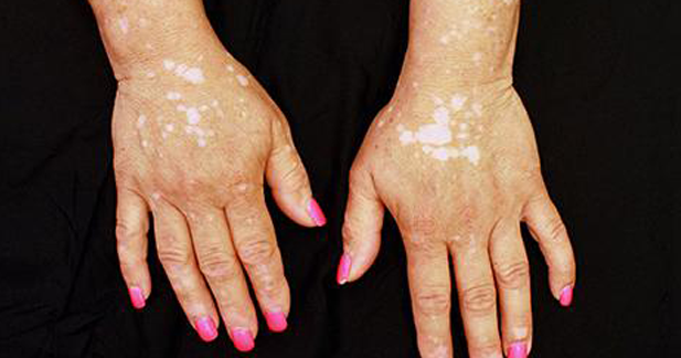 Arthritis drug treats woman's vitiligo, skin pigment condition CBS News