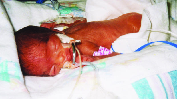 Survival rates for extremely premature babies improve ...