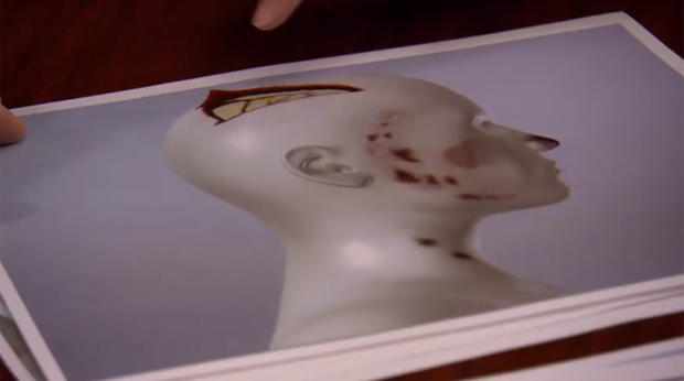 A model of Leslie Neulander's head injuries 