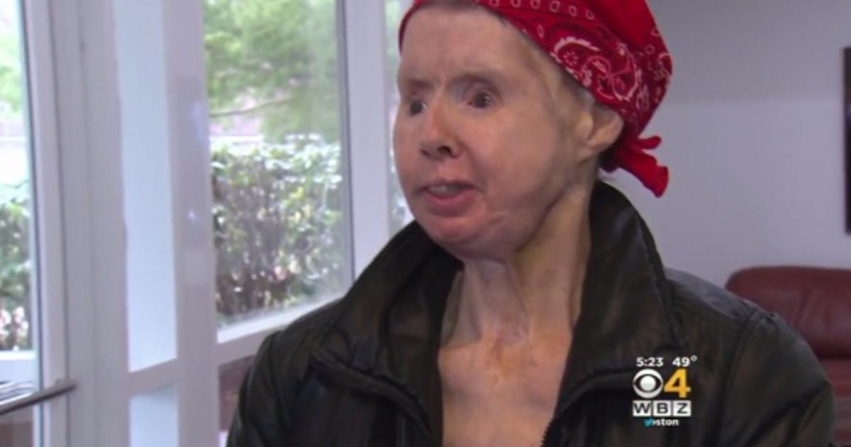 5 years after chimp attack, woman helps doctors study treatment - CBS News
