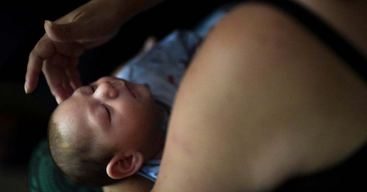 More birth defects in U.S. areas with local Zika spread
