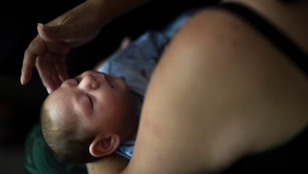CDC: Spike in 2016 birth defects linked to Zika CDC: Spike in 2016 birth defects linked to Zika
