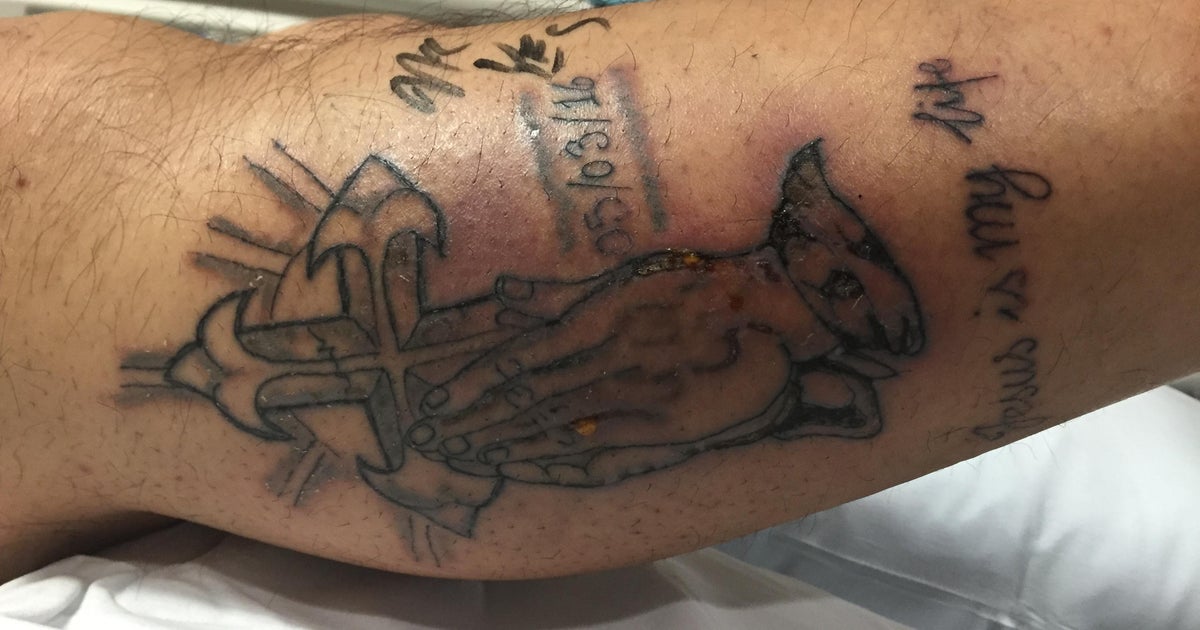 man dies after flesh eating bacteria infects new tattoo cbs news man dies after flesh eating bacteria infects new tattoo cbs news