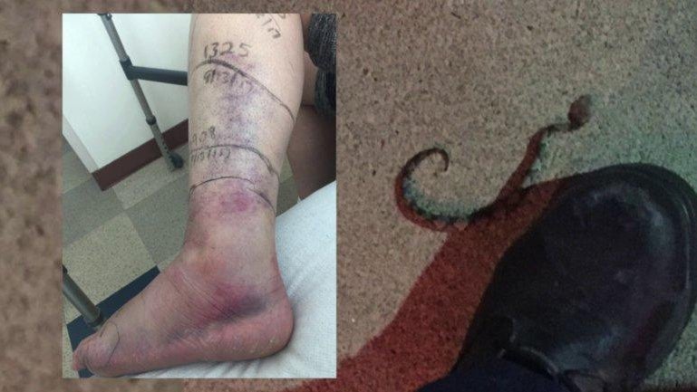 Insane snake attacks (WARNING GRAPHIC IMAGES) CBS News