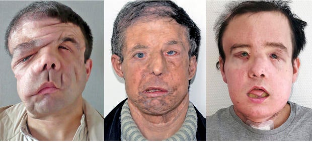 Double Face Transplant