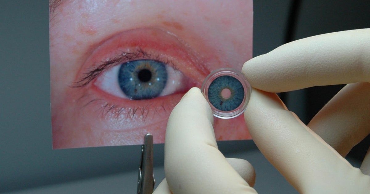 FDA approves first artificial iris CBS News