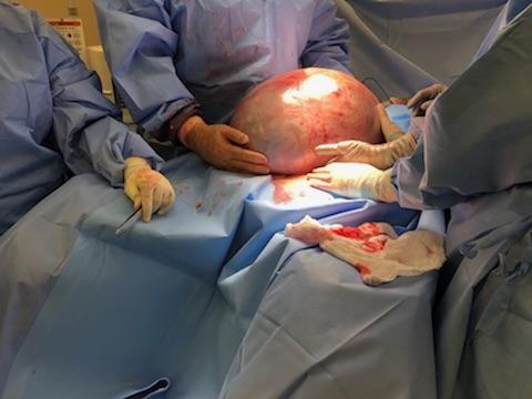 Alabama woman has 50pound cyst removed from her ovary