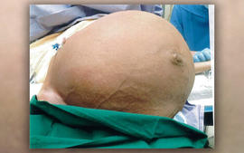 giant-fibroid.jpg 