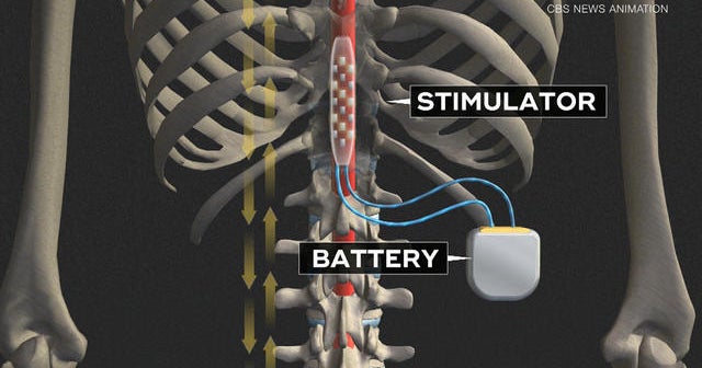 Experimental device helping paralyzed patients walk again
