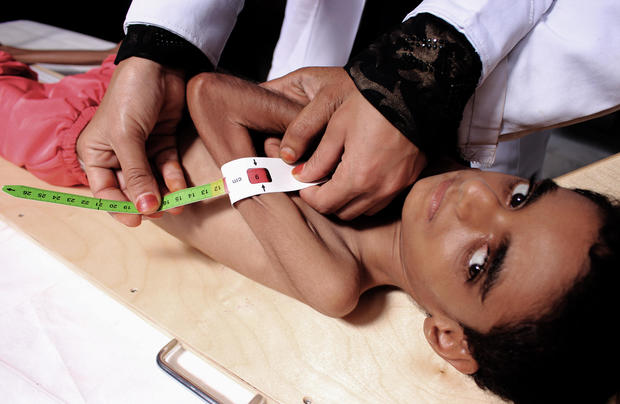 MALNUTRITION YEMEN-CONFLICT 