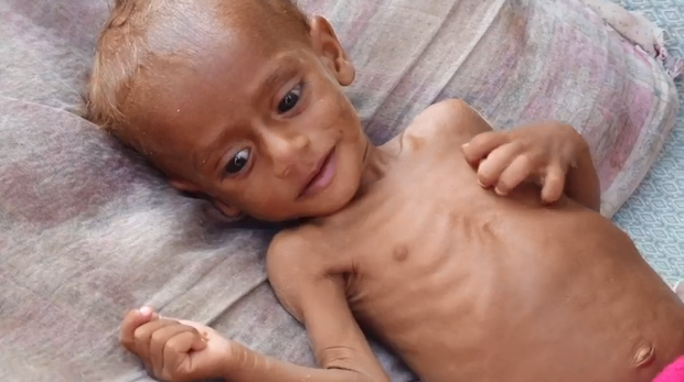 181120-yemen-civil-war-children-malnutrition-03.png