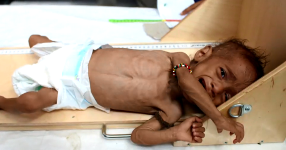 Yemen&#39;s most innocent victims: 85,000 children under 5 may have died from  starvation, report says - CBS News