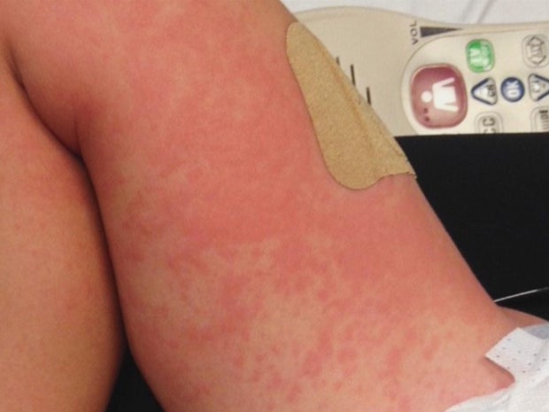 An End To Food Allergies A Possible Answer To Severe Reactions To 