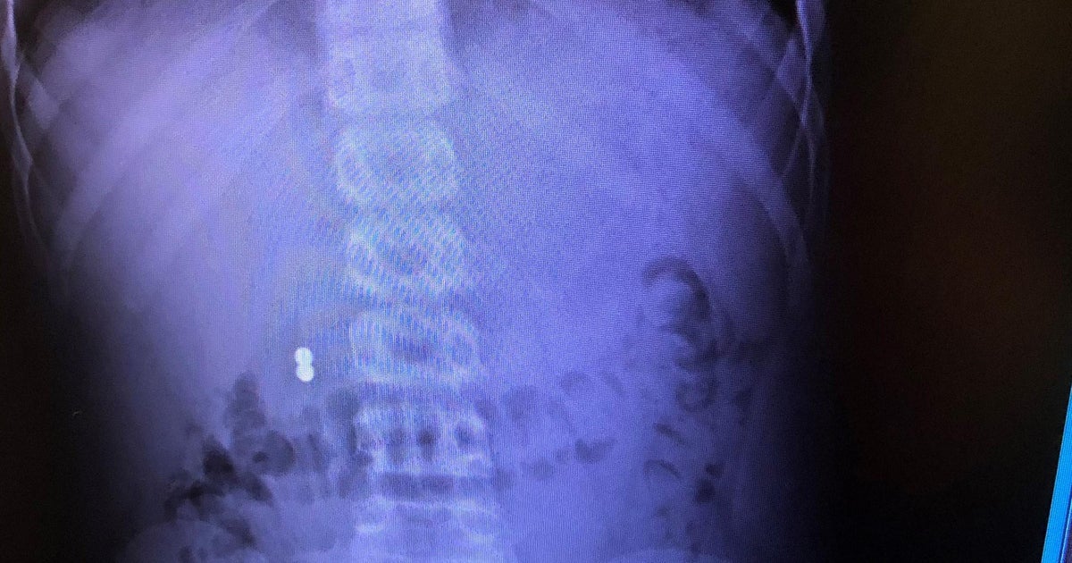 Doctors sound the alarm on the dangers of kids swallowing CBS
