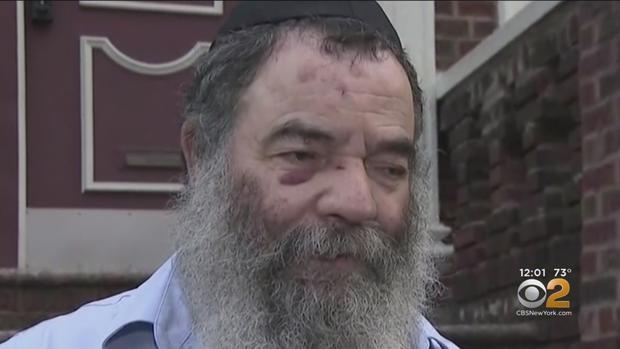 Victim speaks after suspected anti-semitic attack 