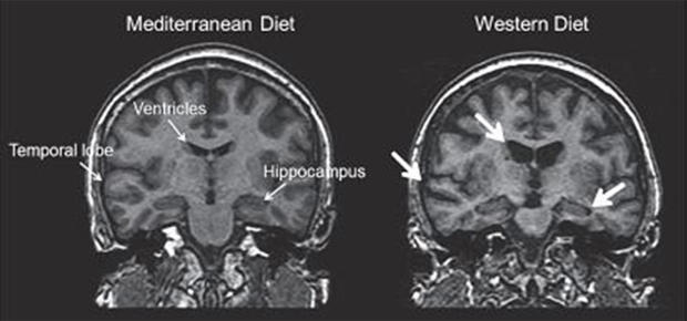 brain-food-mri-scans-620.jpg 