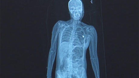lodox-x-ray-image.jpg 