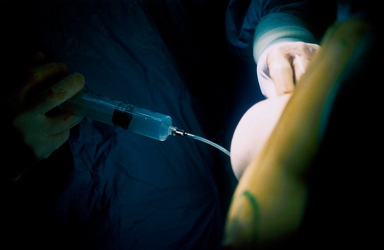 45. Cardiac ablation Most expensive medical procedures in the U.S