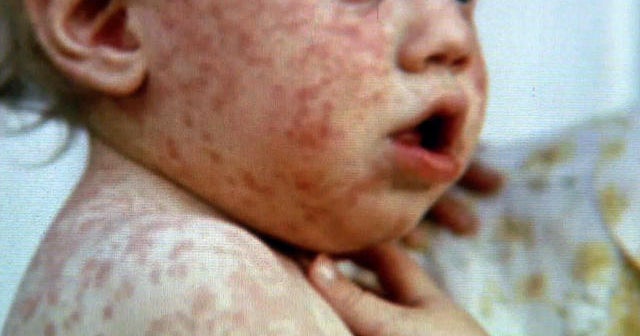 Major measles outbreak in Orange County, Calif.