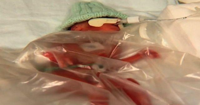 California woman gives birth to 14-ounce baby