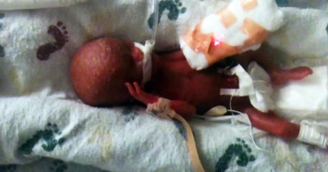 Born 13-ounces, premature baby defying the odds