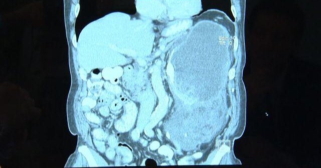 New York doctors save patient with 20-pound tumor