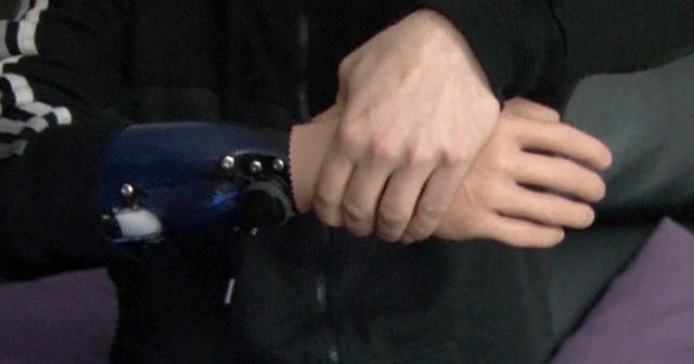 Bionic hands controlled with the brain