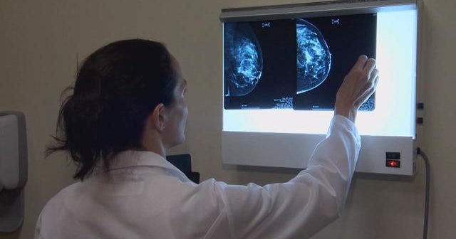 New study helps doctors spot breast cancer risks