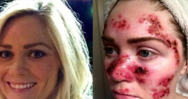Woman posts skin cancer selfie as warning to others