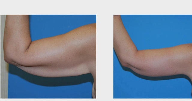 Rise in plastic surgery after major weight loss