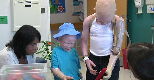 African children with albinism targeted by poachers