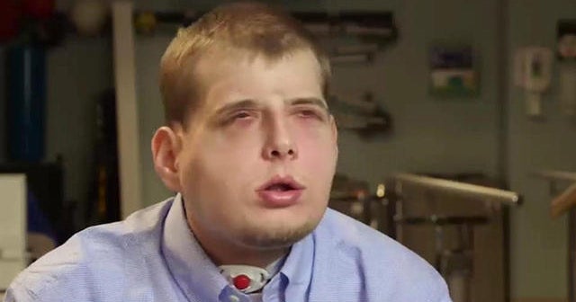 Firefighter receives extensive facial transplant surgery