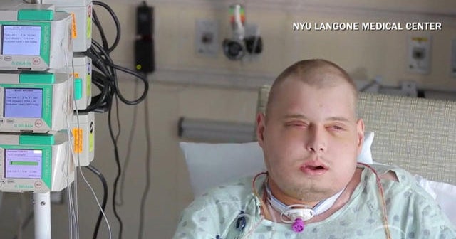 Most extensive full face transplant patient recovering