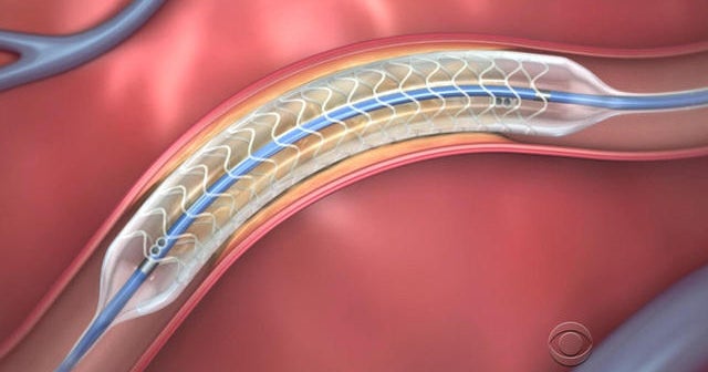 U.S. surgeons implant first dissolvable stent